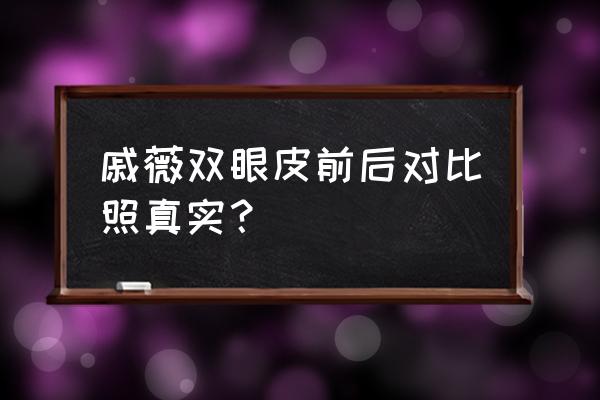 戚薇整容失败破相 戚薇双眼皮前后对比照真实？